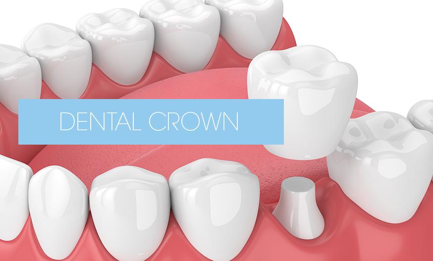 dental crown
