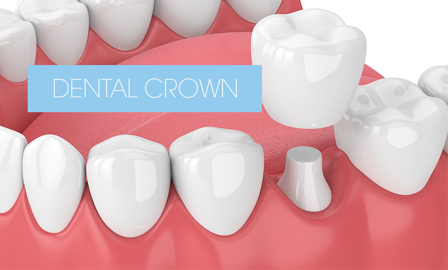 illustration of how a dental crown works