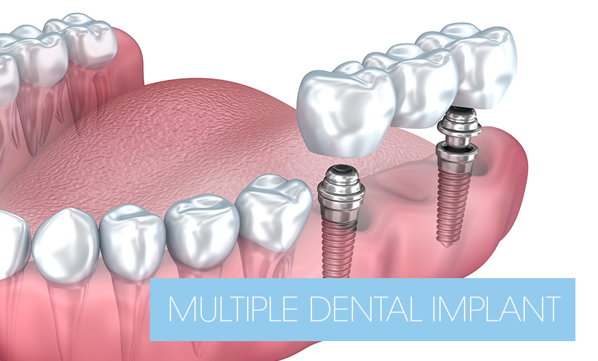 multiple teeth supported on dental implants