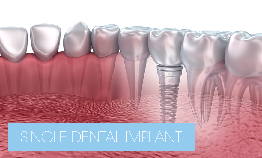 single dental implant at Loy Dental Care