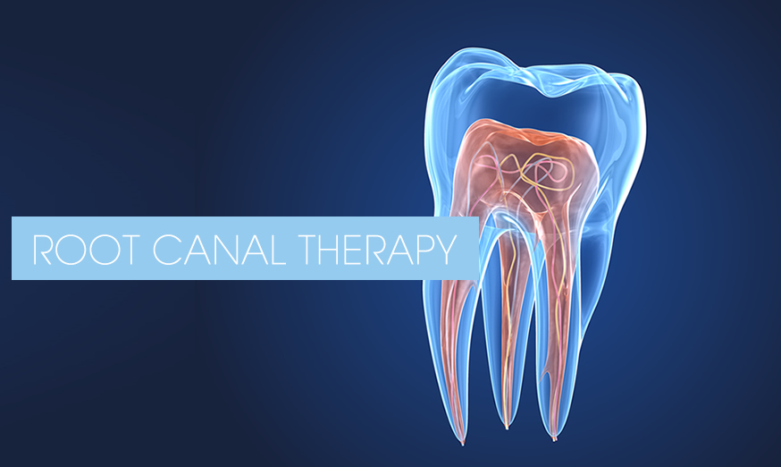 graphic shoeing tooth structure for root canal therapy in Cookstown