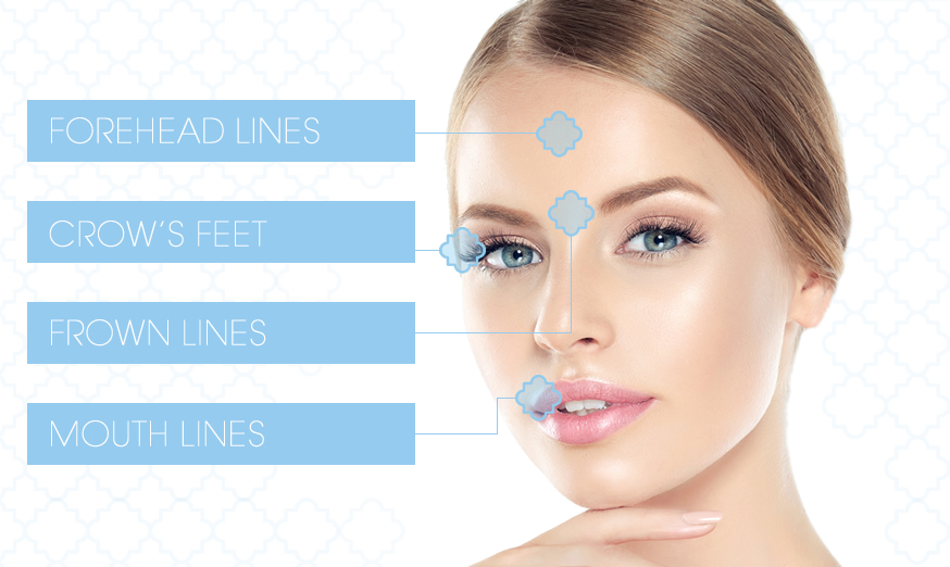 image showing which areas Dr O'Hare can target with Botox at the skin clinic