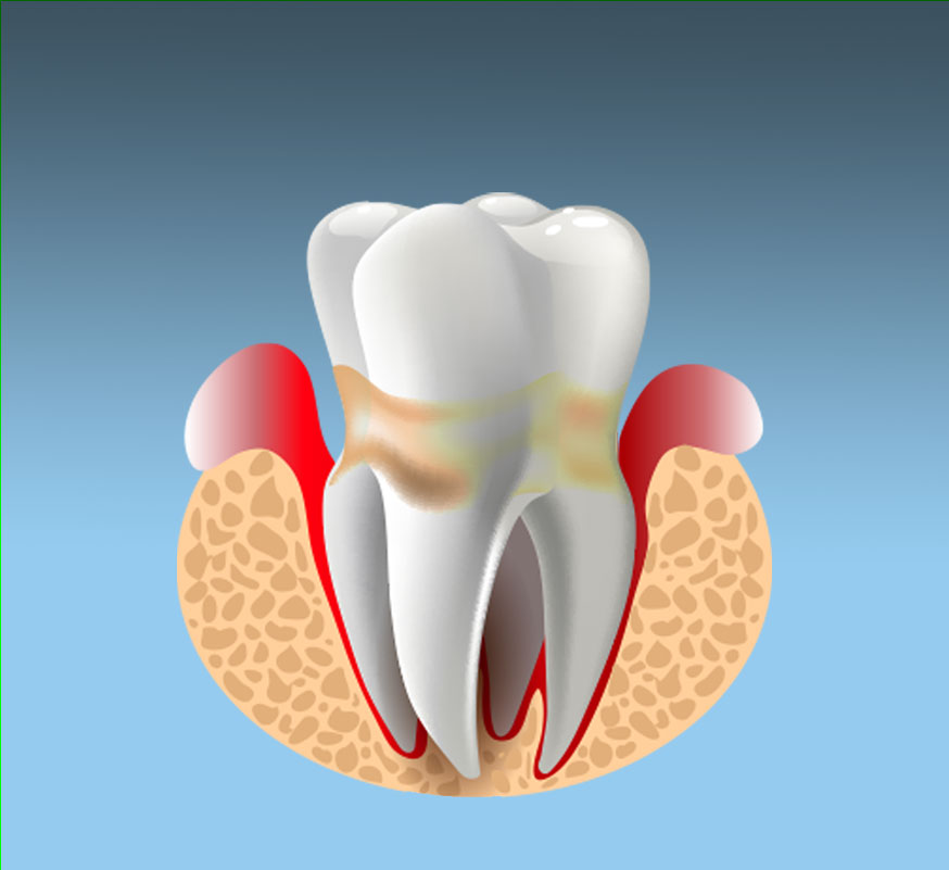graphic of tooth with gum disease