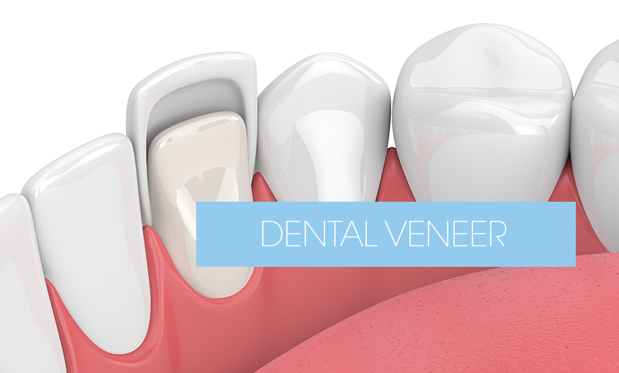 dental veneer